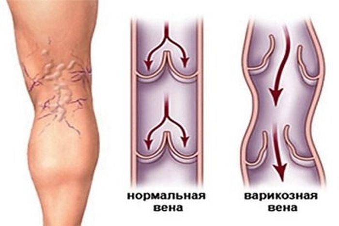 Варикоз Вен На Ногах Причины