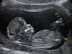 Ohio abortions drop to 40-year low