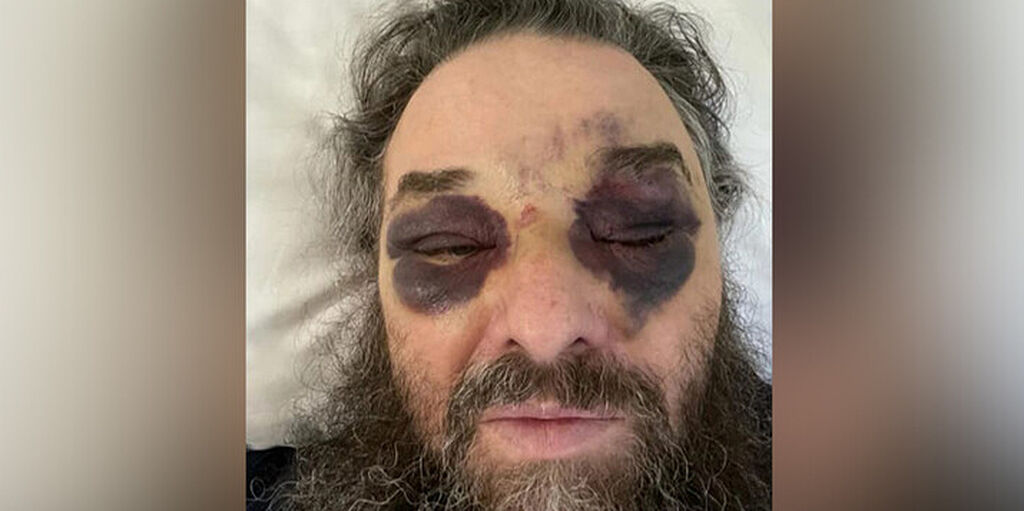 Θύμα ξυλοδαρμού ο Μητροπολίτης Μπάντσεν Λογγίνος